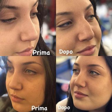 Protesi naso ex pugile silicone