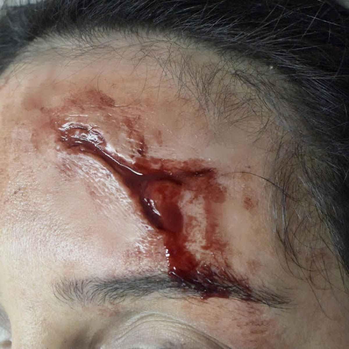 Protesi lesione a y silicone