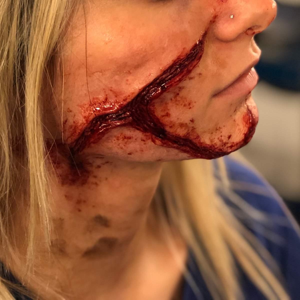 Protesi squarcio a y silicone