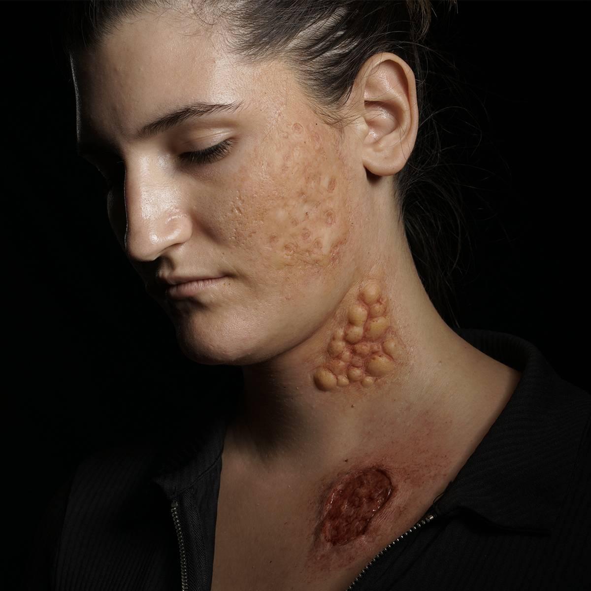 PROTESI SET BOLLE - USTIONE - SQUARCIO<br />