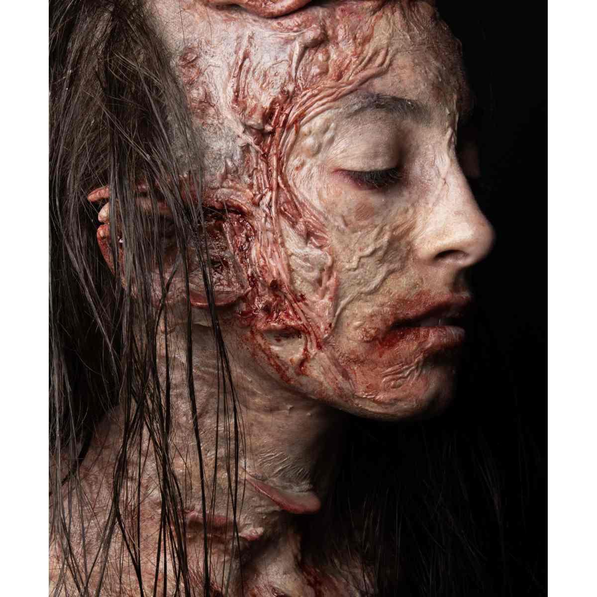 Protesi guancia infetta in silicone