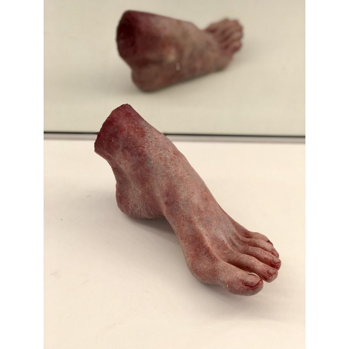 Pes-Livor | <br />Piede Livido con Discromie Post-Mortem